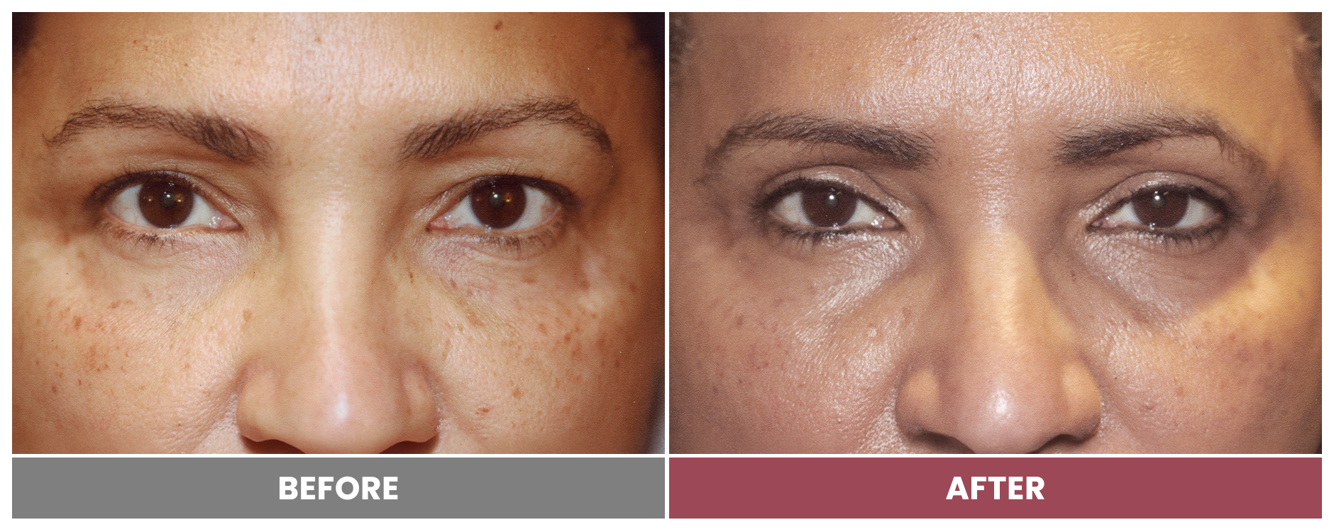 Upper Blepharoplasty - Case 12